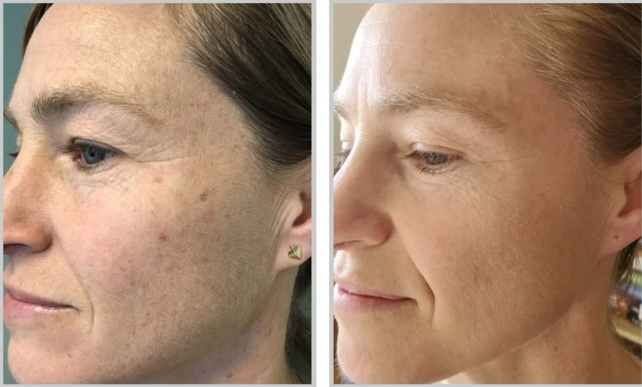 BBL HEROic Photofacial in Austin, TX | Maui MedSpa